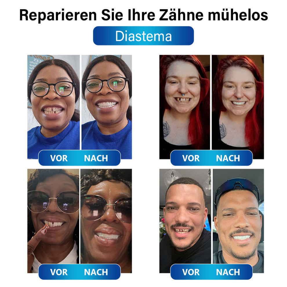 Dental-Blaulicht-Reparaturset | Schnelle Lösung für Zahnrestaurationen