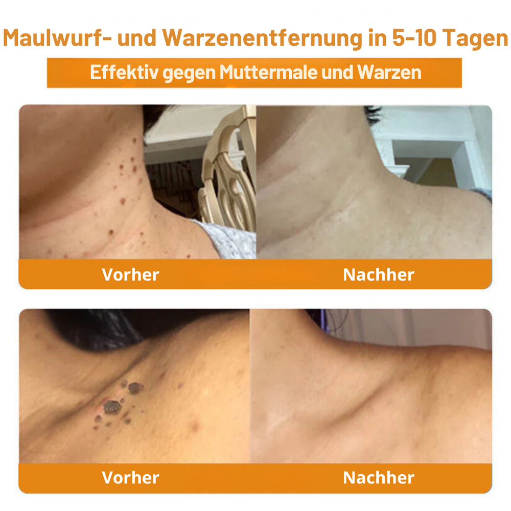 Bienengift Hautcreme | Warzen- & Tag-Entferner