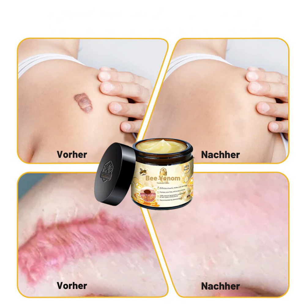 Bienengift Hautcreme | Warzen- & Tag-Entferner