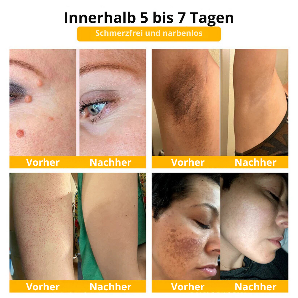 Bienengift Hautcreme | Warzen- & Tag-Entferner