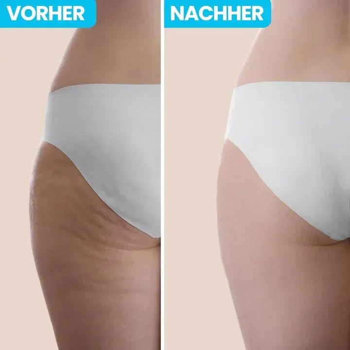 Anti-Cellulite Massagegerät | Glatte Haut leicht gemacht